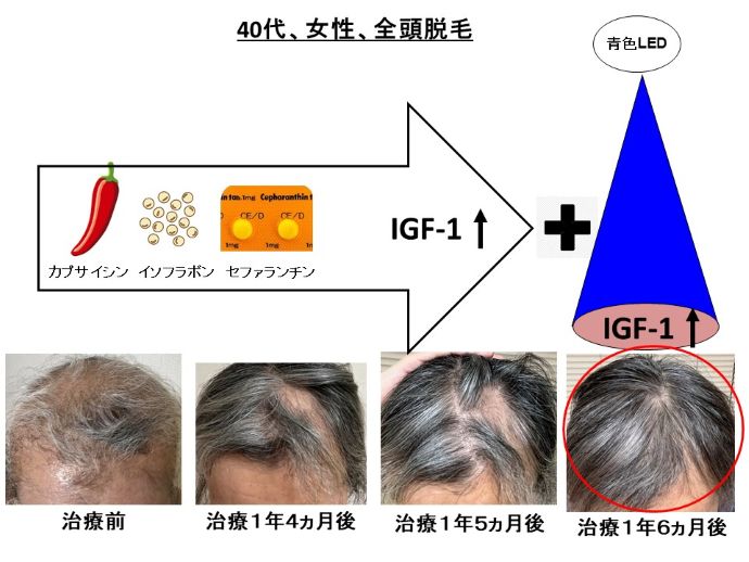 円形脱毛症　病院